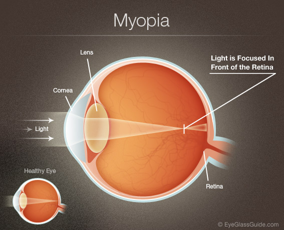 Light entering the eye is focused by the Lens and Cornea to a single point in front of the Retina